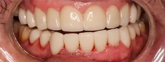 Primer plano de dientes superiores e inferiores con encías visibles e interior de la boca