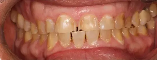 Primer plano de dientes con decoloración amarilla, acumulación de placa y manchas oscuras visibles