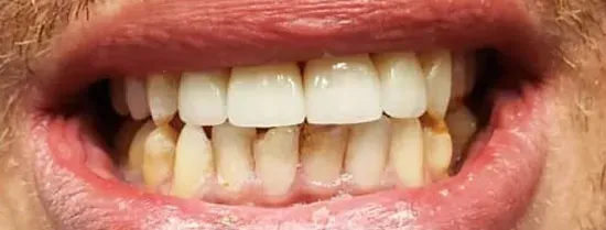 Primer plano de la boca de una persona mostrando dientes con decoloración y manchas cerca de las encías