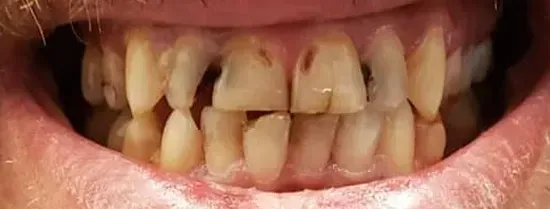 Primer plano de la boca de una persona mostrando dientes severamente decolorados, desgastados y desalineados