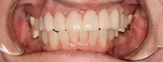 Primer plano de la boca de una persona mostrando dientes superiores e inferiores con retractores dentales