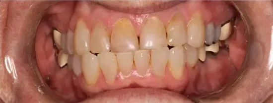 Primer plano de los dientes de una persona mostrando decoloración, manchas y tejido de las encías