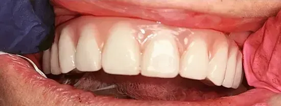 Primer plano de dientes superiores con restauración dental, retraídos por dedos enguantados