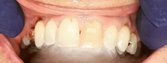 Primer plano de dientes frontales superiores con decoloración, dedos enguantados retrayendo los labios