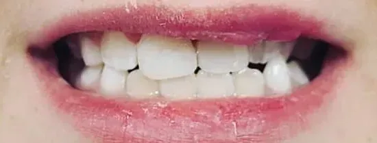 Primer plano de una boca sonriente mostrando dientes frontales superiores y labios rosados