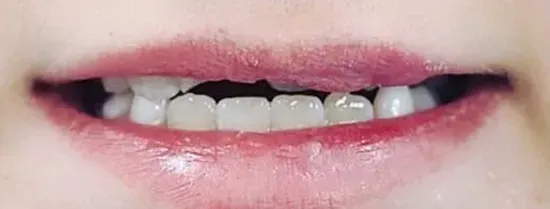 Primer plano de la boca sonriente de una persona mostrando dientes superiores e inferiores