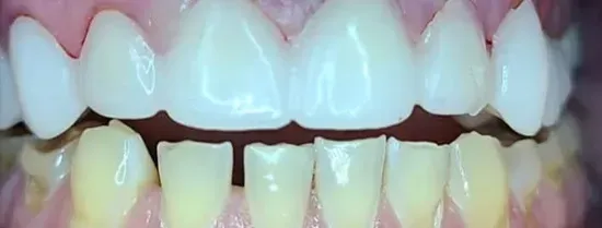Primer plano de dientes superiores e inferiores mostrando contraste de color entre la fila superior blanqueada y la fila inferior natural