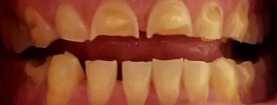 Primer plano de dientes con decoloración amarilla y acumulación visible de sarro, boca abierta