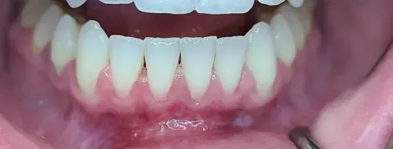 Primer plano de dientes inferiores y encías con un espejo dental reflejando debajo