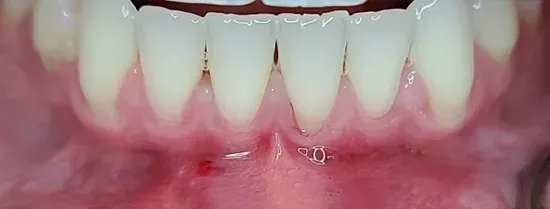 Primer plano de dientes frontales inferiores con recesión visible de encías y sangrado leve