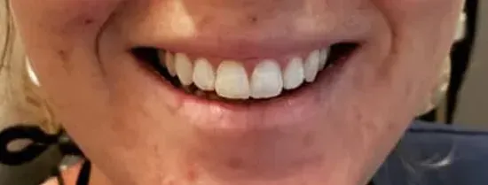 Primer plano de una boca sonriente mostrando dientes superiores e inferiores blancos