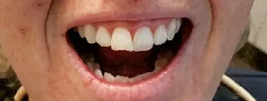 Primer plano de la boca abierta de una persona mostrando dientes superiores y labios sonrientes