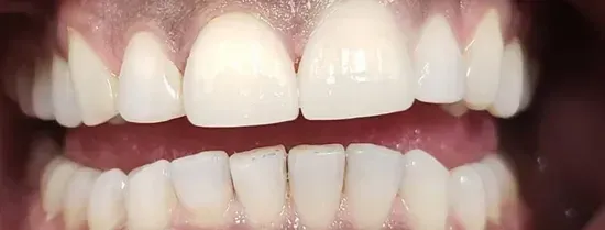 Primer plano de dientes superiores e inferiores mostrando una sonrisa blanca y saludable y encías
