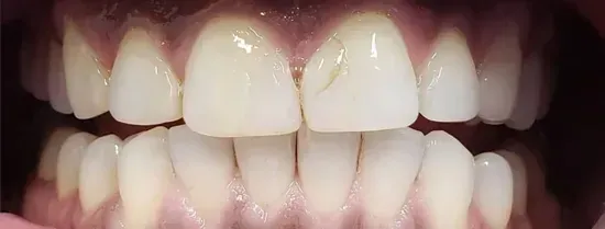 Vista de cerca de dientes frontales superiores e inferiores y encías, boca abierta