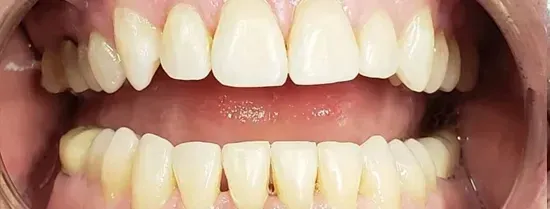 Primer plano de dientes superiores e inferiores mostrando ligero amarillamiento y tejido de las encías