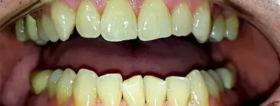 Primer plano de los dientes de una persona mostrando decoloración amarilla y encías