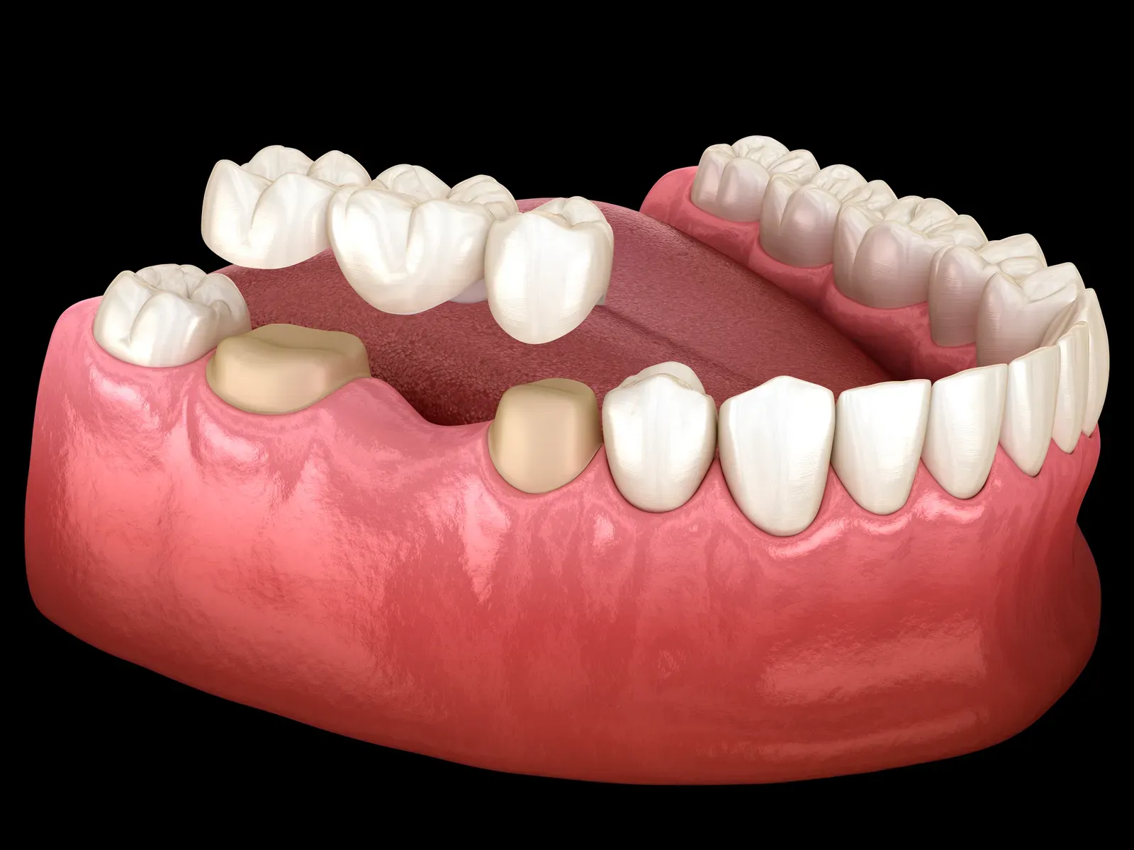 Photo related to dental crowns