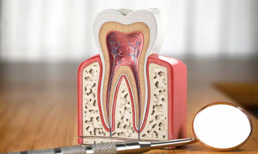 pain after a root canal
